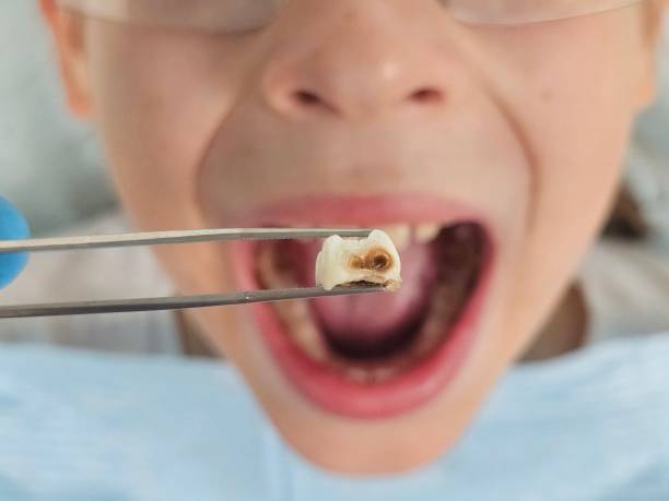Best Tooth Infection Emergency Dentist  in Lincoln Village, OH